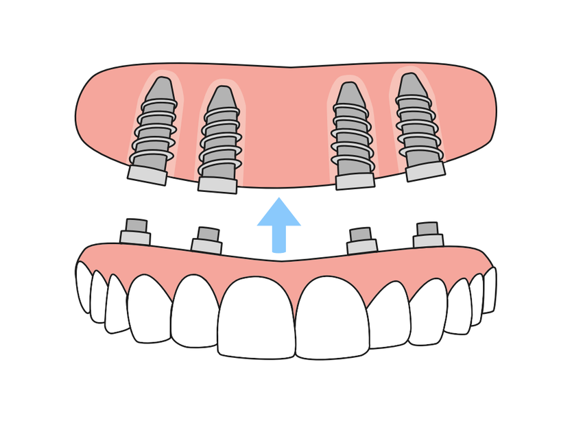 Diagram of a full denture anchored securely on four dental implants