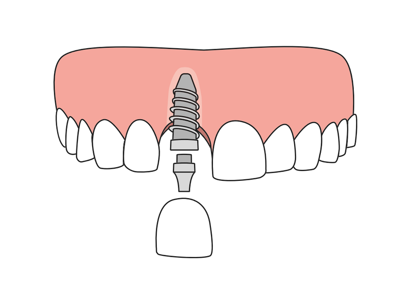 Diagram of a single titanium dental implant replacing one missing tooth