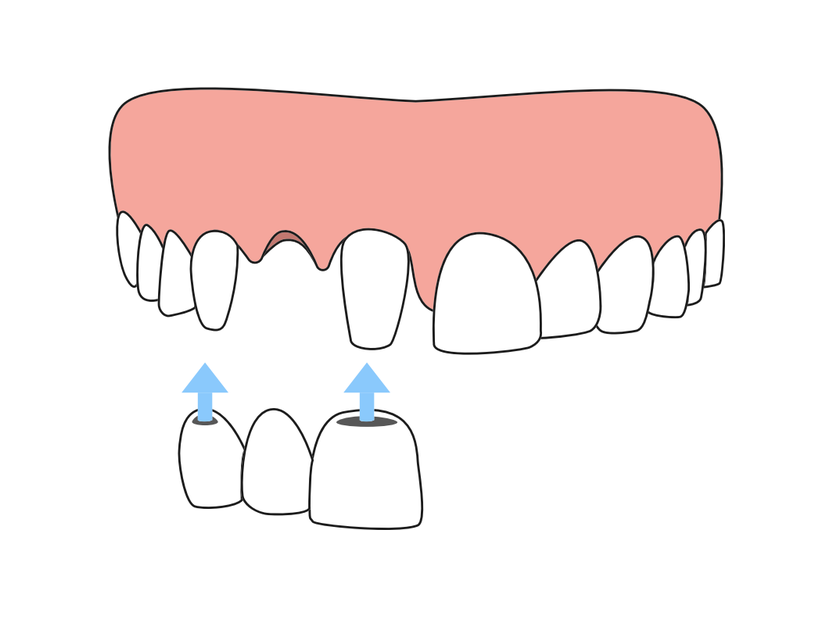 Diagram of a dental bridge supported by two dental implants